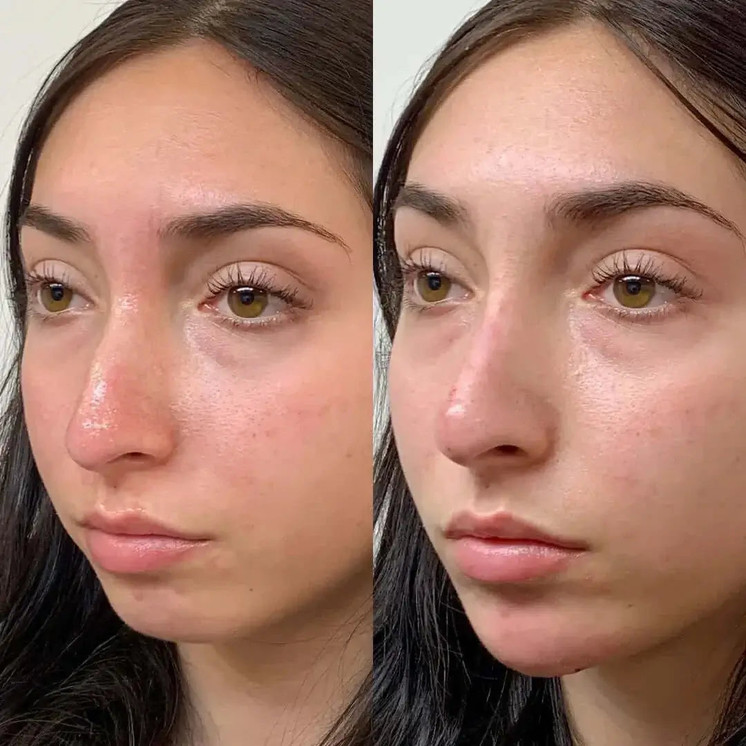 NoseFix: Filler