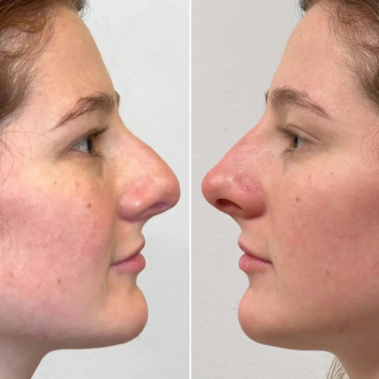 NoseFix: Filler