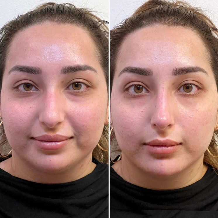NoseFix: Slimming