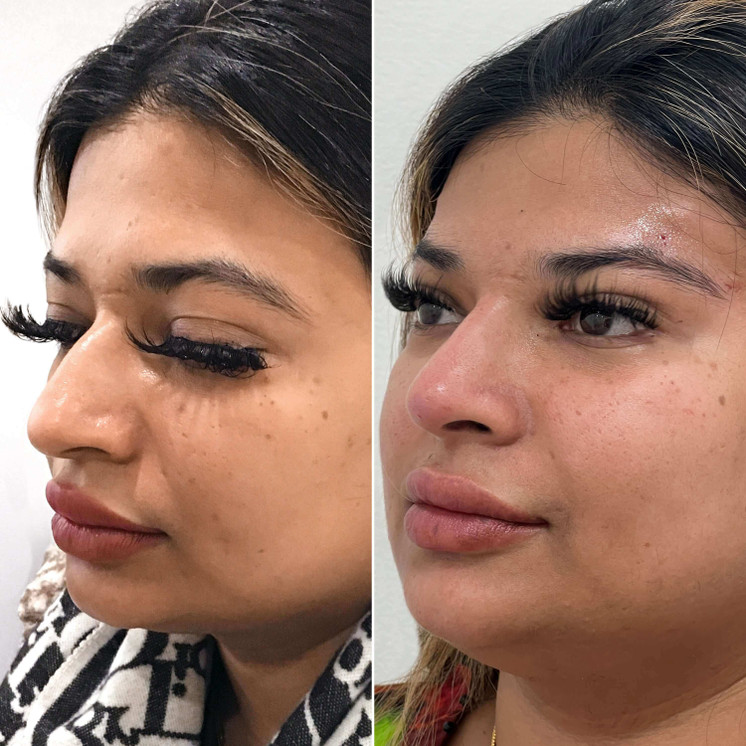 NoseFix: Slimming