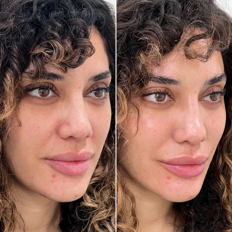 SkinFix: Hydrafacial