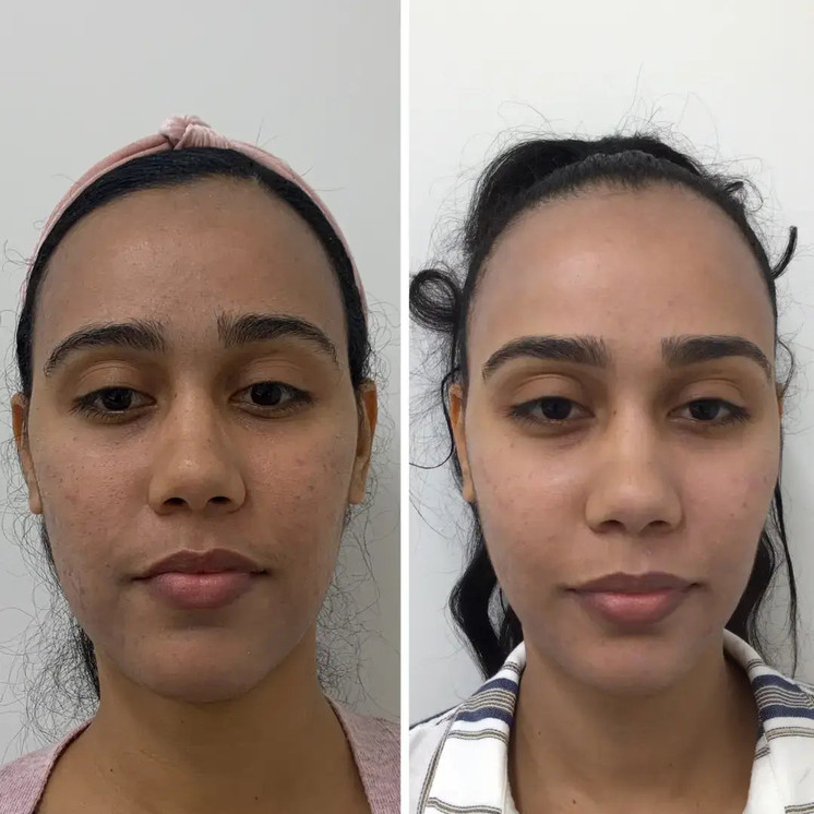 SkinFix: Hydrafacial