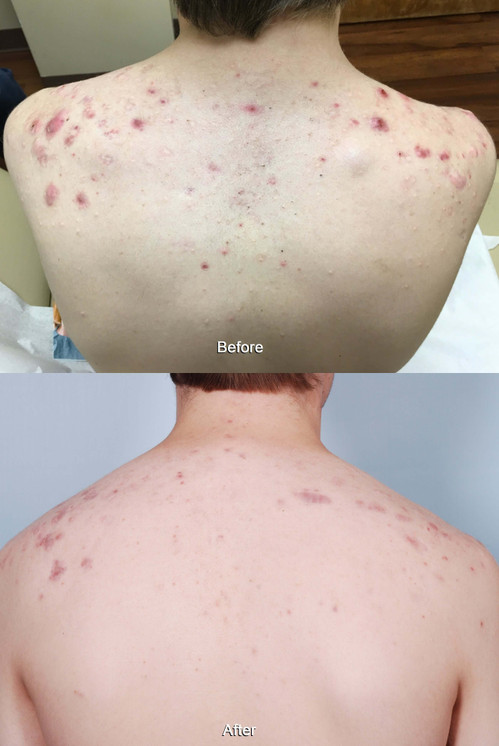SkinFix: IPL