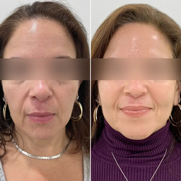 SkinFix: Microneedling