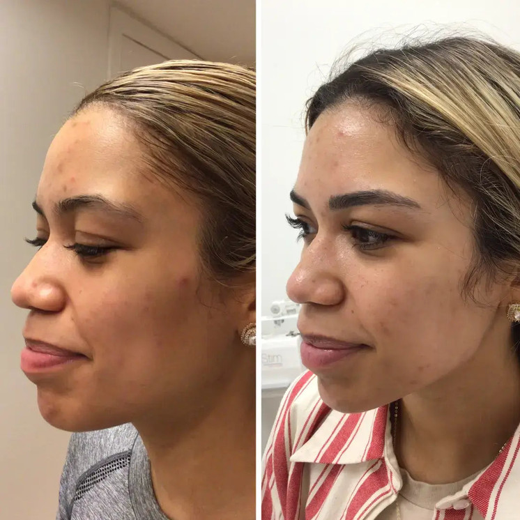 SkinFix: Microneedling