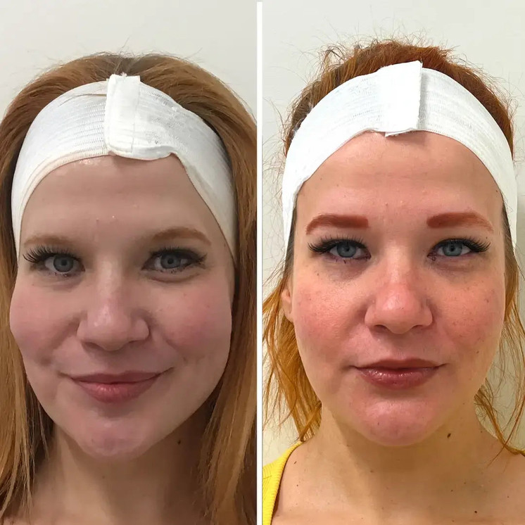 SkinFix: Microneedling