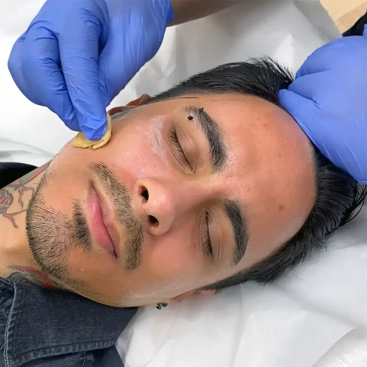 SkinFix: VI Peel