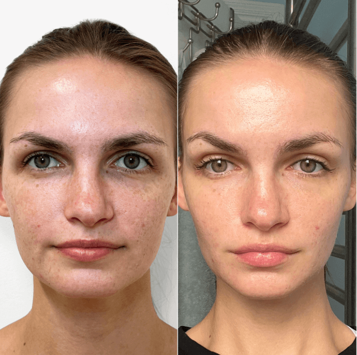 SkinFix: VI Peel