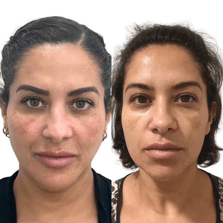 SkinFix: VI Peel
