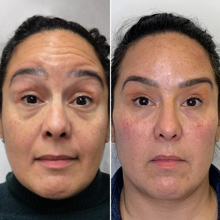 WrinkleFix: Botox (Existing Customers)