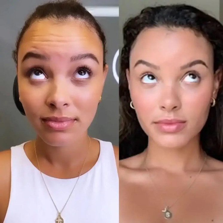 WrinkleFix: Botox (Existing Customers)