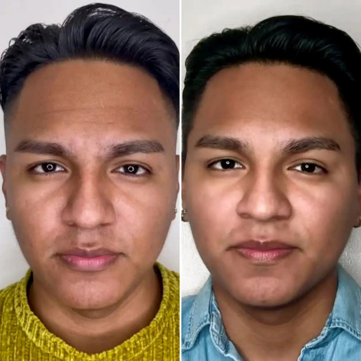 WrinkleFix: Botox (Existing Customers)
