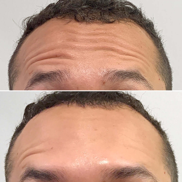 WrinkleFix: Botox (Existing Customers)