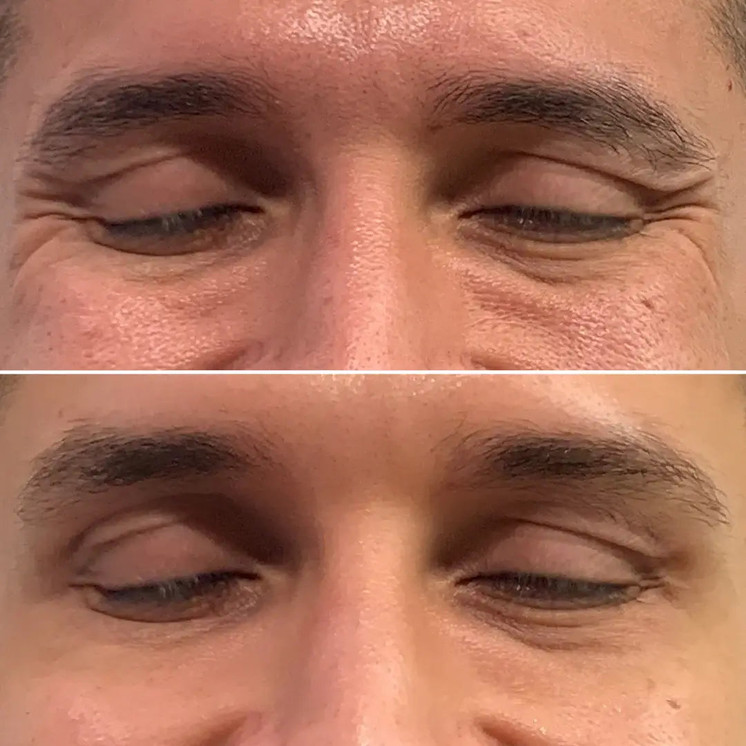 WrinkleFix: Botox (First-Time)