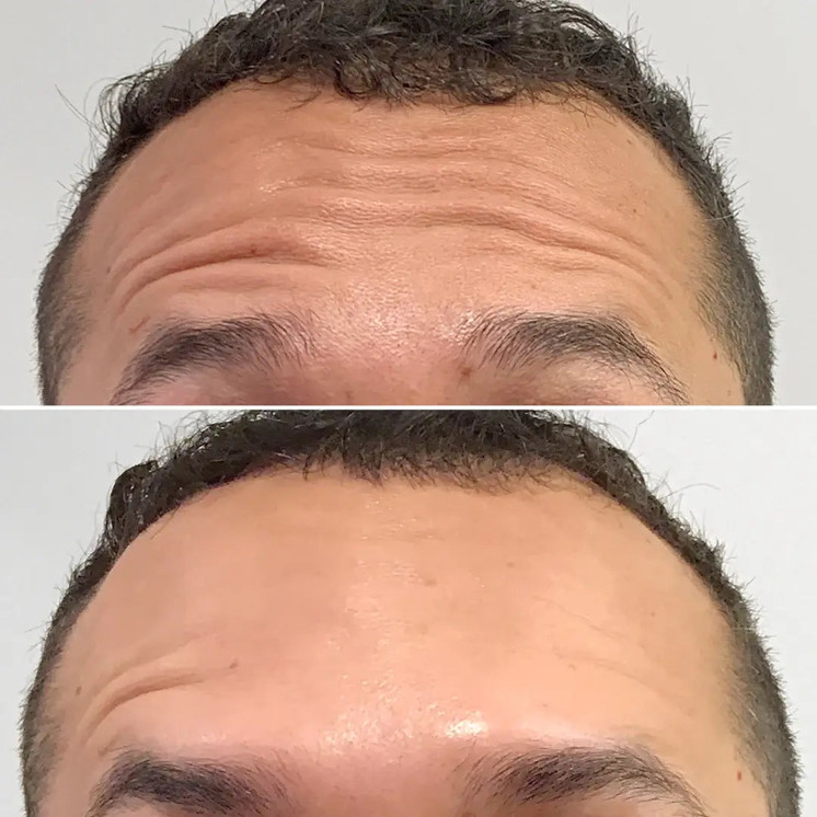WrinkleFix: Botox (First-Time)