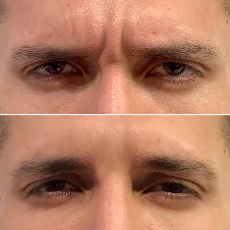 WrinkleFix: Botox (First-Time)