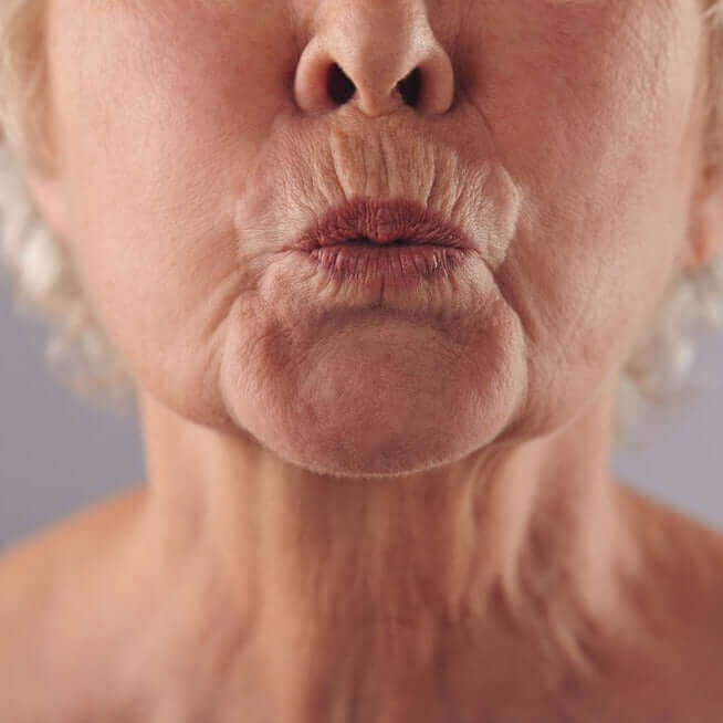 WrinkleFix: Smoker's Lines
