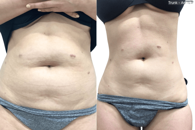 AbFix: truSculpt iD