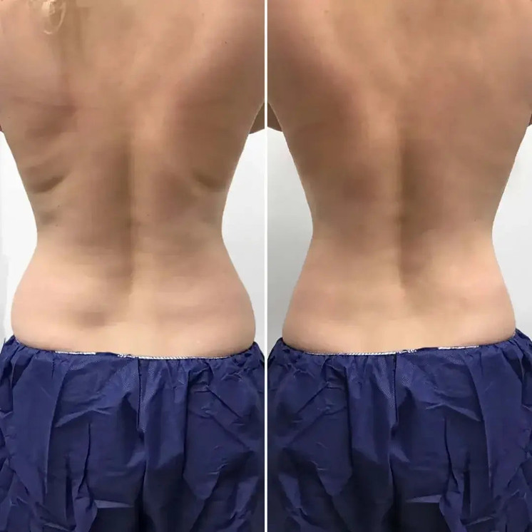 BodyFix: CoolSculpting® Elite