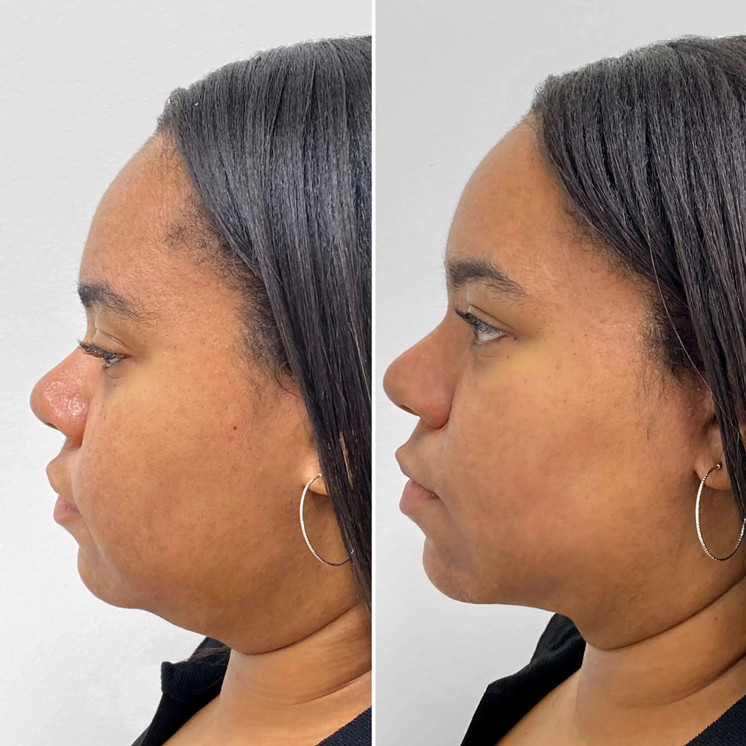 BodyFix: CoolSculpting® Elite