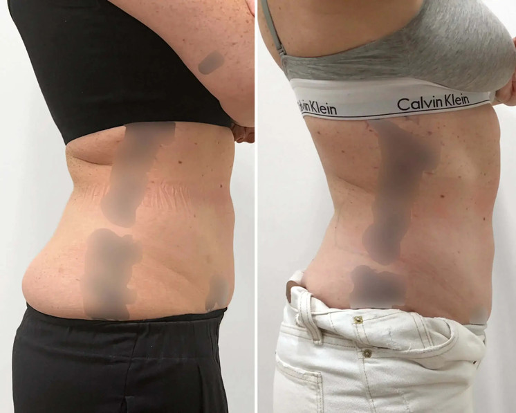 BodyFix: CoolSculpting® Elite