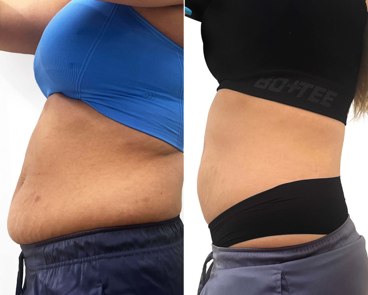 BodyFix: CoolSculpting® Elite