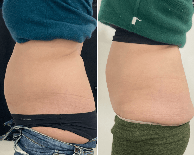 BodyFix: CoolSculpting® Elite
