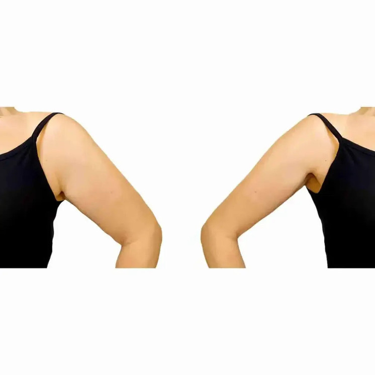 ArmFix: truSculpt iD