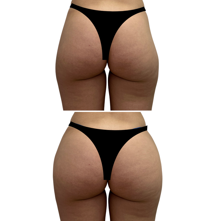 BootyFix: AlloClae™ Filler