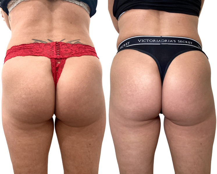 BootyFix: Butt Vacuum