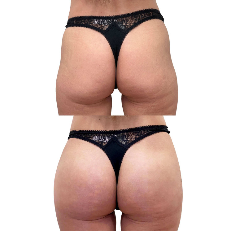BootyFix: Radiesse Butt Lift