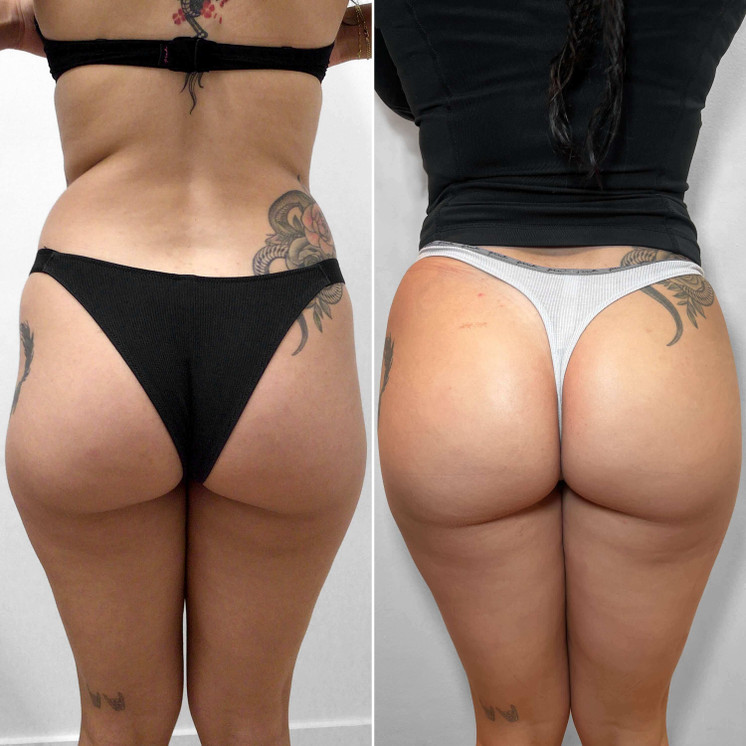 BootyFix: Radiesse Butt Lift
