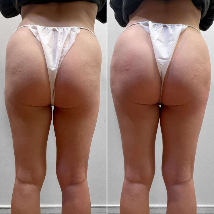 BootyFix: Radiesse Butt Lift