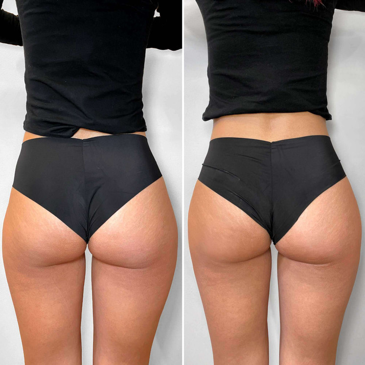 BootyFix: Radiesse Butt Lift