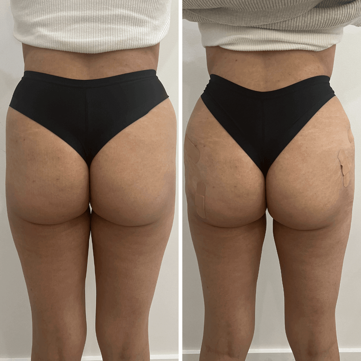 BootyFix: Sculptra Butt Lift