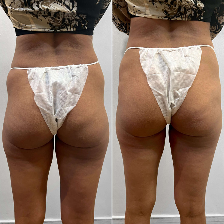 BootyFix: Sculptra Butt Lift