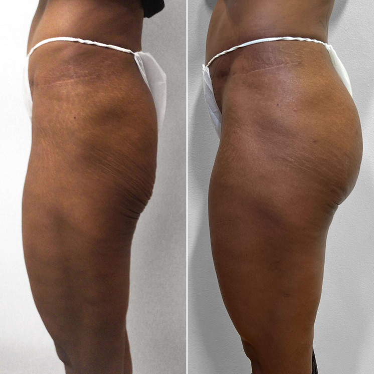 BootyFix: Sculptra Butt Lift