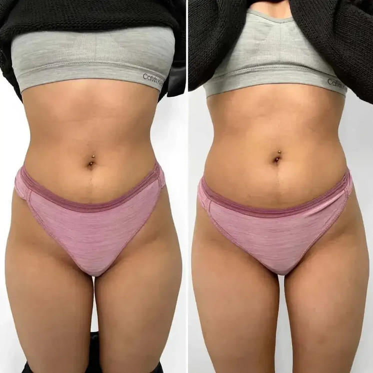 BootyFix: Sculptra Butt Lift