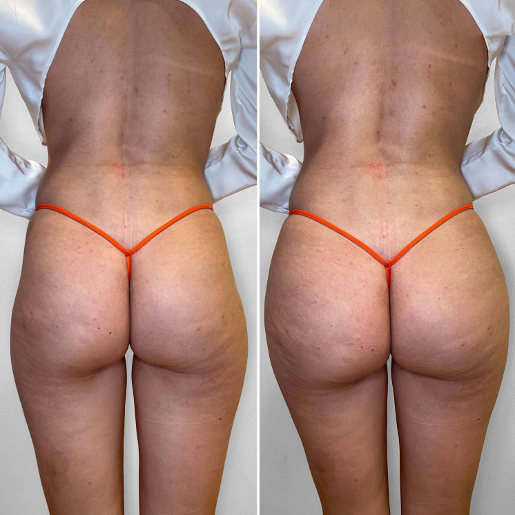BootyFix: Skinny BBL