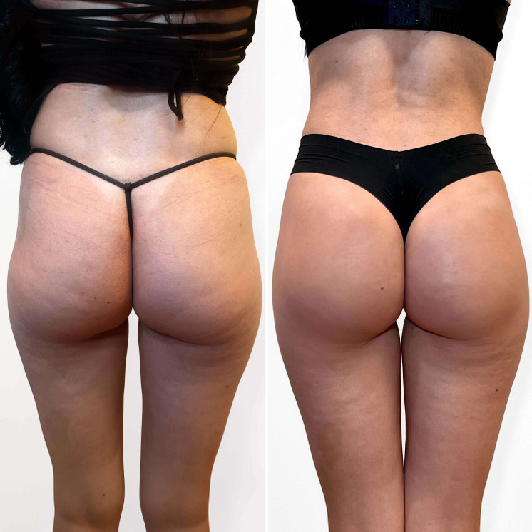 BootyFix: Skinny BBL