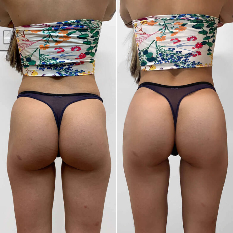 BootyFix: Skinny BBL