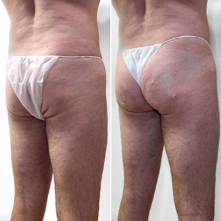 BootyFix: Ultimate BBL for Men