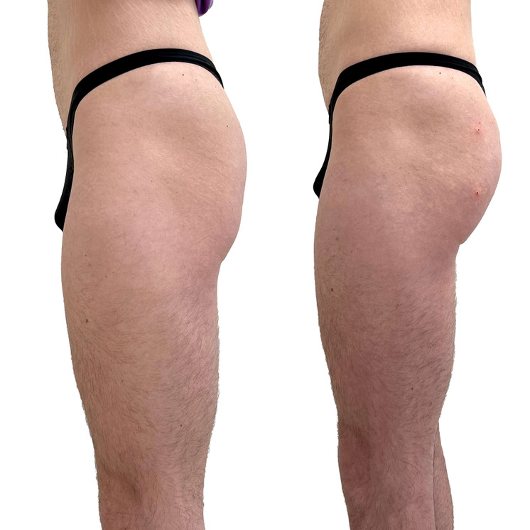 BootyFix: Ultimate BBL for Men