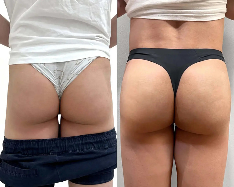 BootyFix: Ultimate BBL for Men