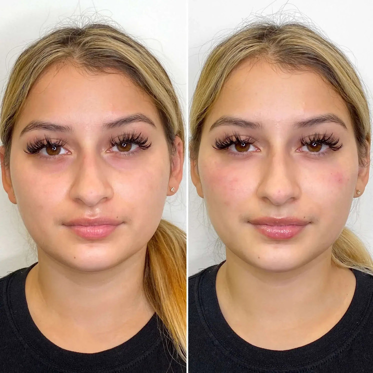 CheekFix: Filler
