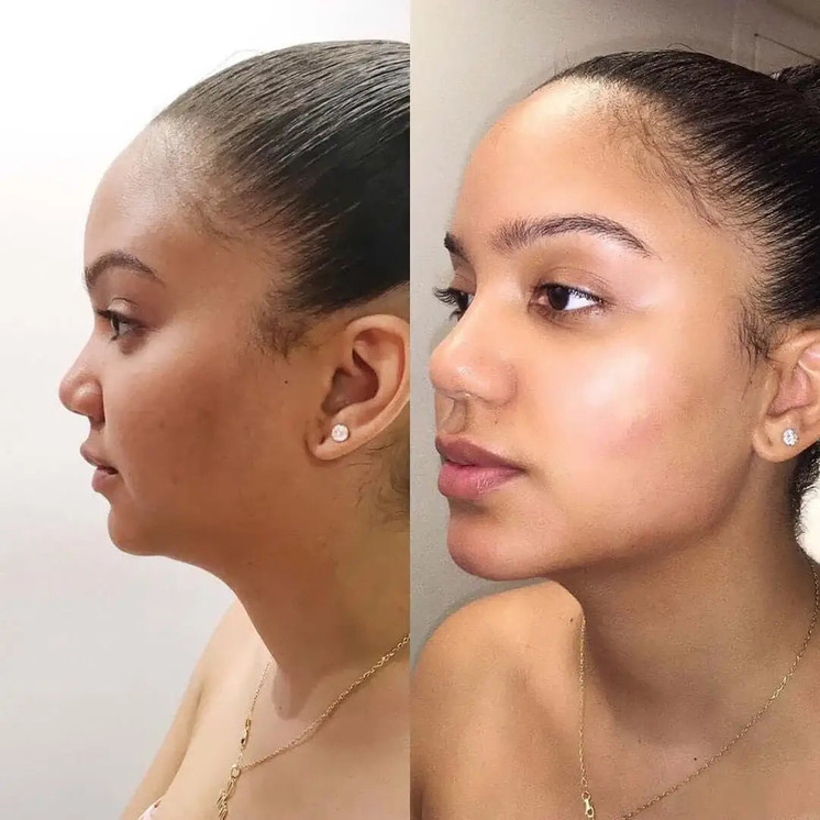 CheekFix: Filler