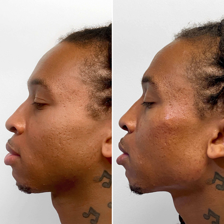 CheekFix: Filler