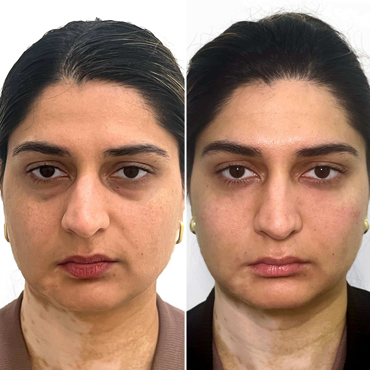 CheekFix: Filler