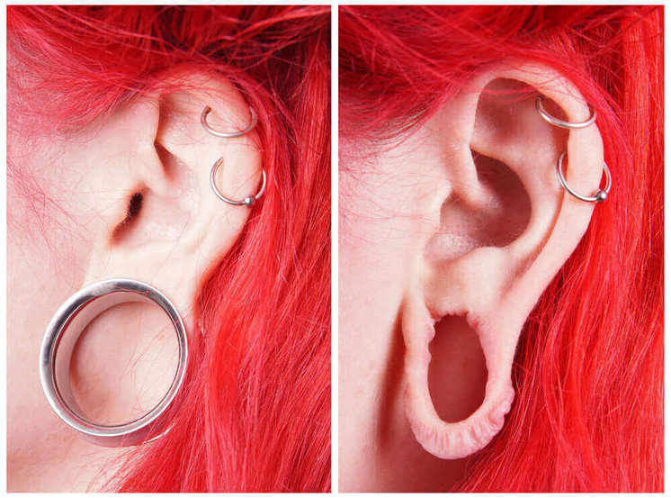 EarFix: Earlobe Repair Surgery