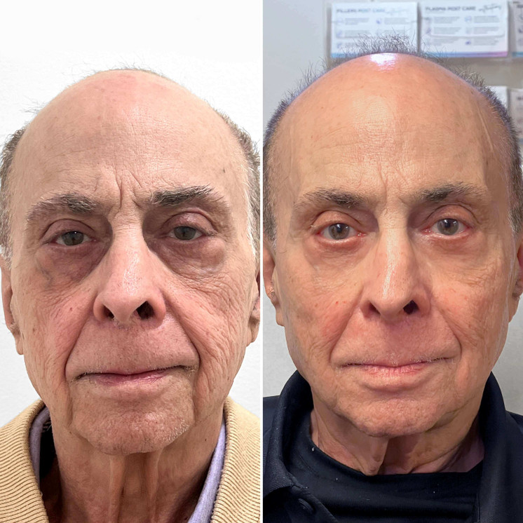 FaceFix: Face Lift for Men